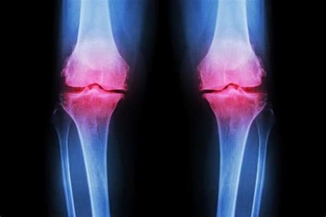 osteoartrita 4 articulatia genunchiului)
